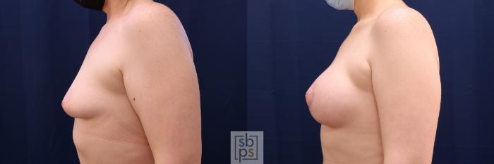 Before & After Breast Augmentation Case 563 Right Side View in Torrance, CA