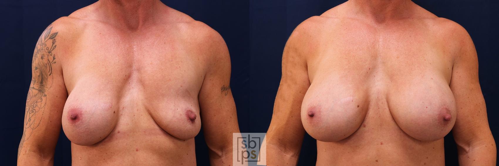 Before & After Breast Augmentation Case 564 Front View in Torrance, CA