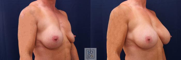 Before & After Breast Augmentation Case 564 Left Oblique View in Torrance, CA