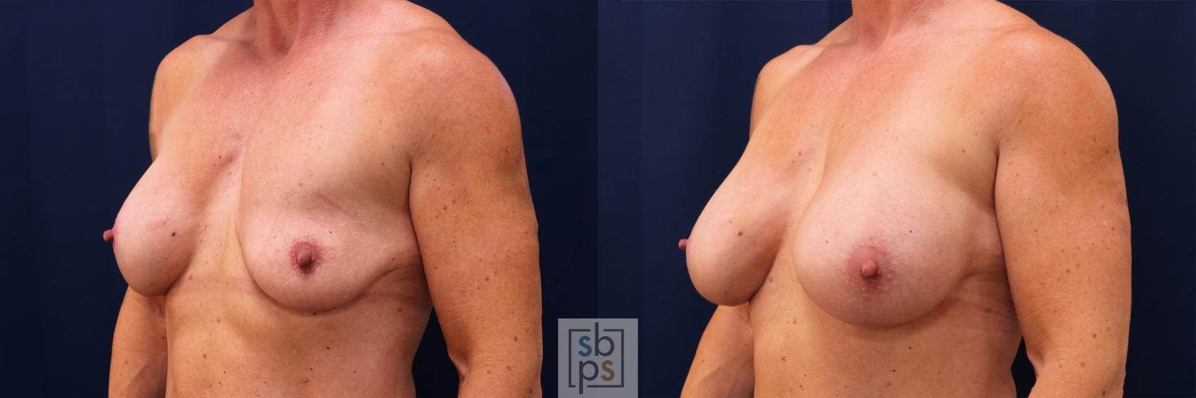 Before & After Breast Augmentation Case 564 Right Oblique View in Los Angeles, Torrance & Long Beach, CA