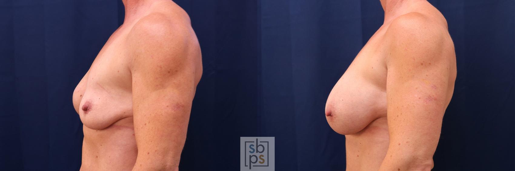 Before & After Breast Augmentation Case 564 Right Side View in Los Angeles, Torrance & Long Beach, CA