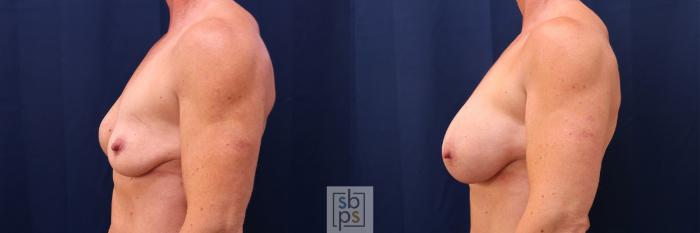 Before & After Breast Augmentation Case 564 Right Side View in Torrance, CA
