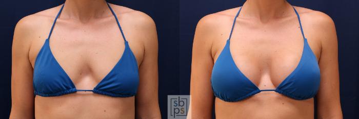 Before & After Breast Augmentation Case 569 Bikini Front View in Torrance, CA