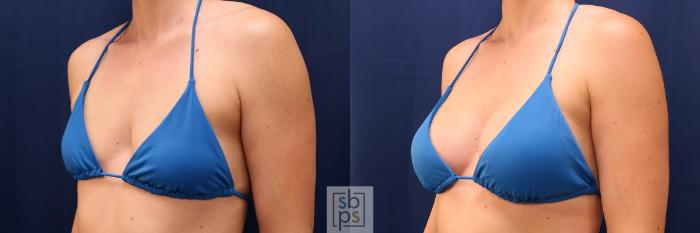 Before & After Breast Augmentation Case 569 Bikini Left Oblique View in Torrance, CA