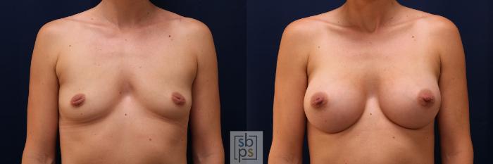 Before & After Breast Augmentation Case 569 Front View in Torrance, CA