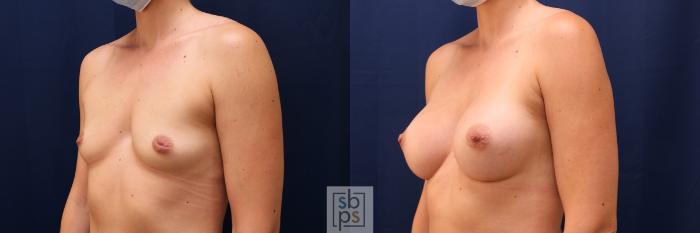 Before & After Breast Augmentation Case 569 Left Oblique View in Torrance, CA