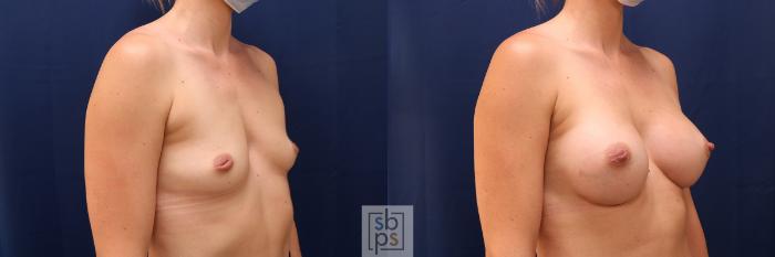 Before & After Breast Augmentation Case 569 Right Oblique View in Torrance, CA