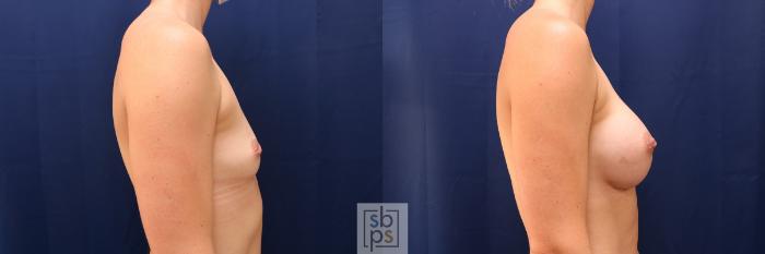 Before & After Breast Augmentation Case 569 Right Side View in Torrance, CA
