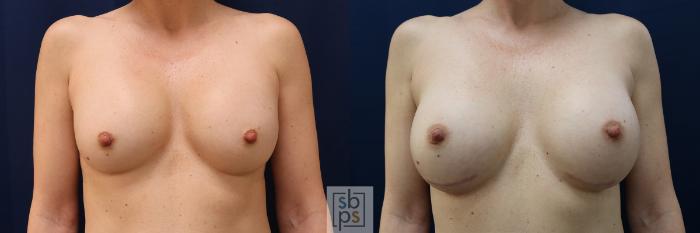 Before & After Breast Augmentation Case 572 Front View in Torrance, CA