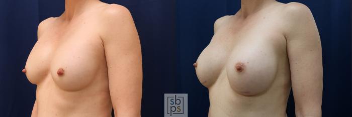 Before & After Breast Augmentation Case 572 Left Oblique View in Torrance, CA