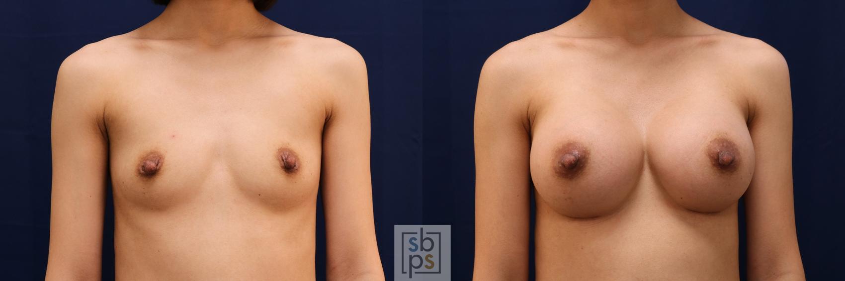 Before & After Breast Augmentation Case 574 Front View in Torrance, CA