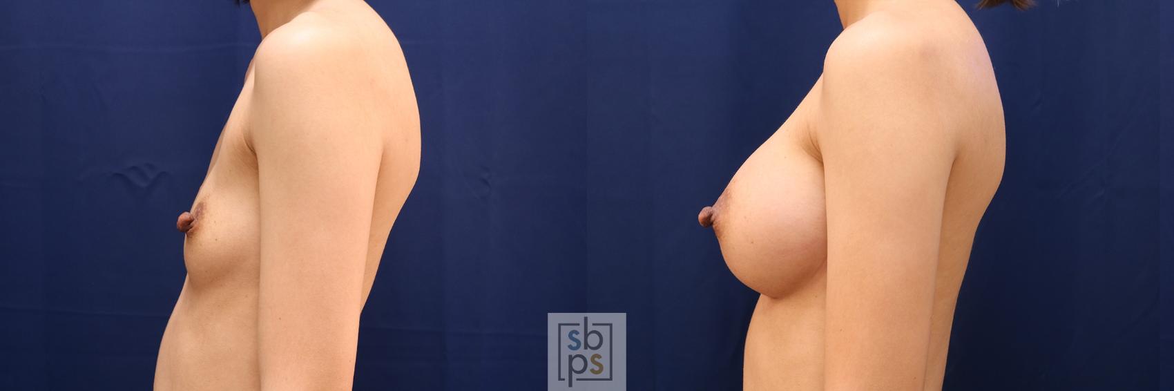 Before & After Breast Augmentation Case 574 Left Side View in Torrance & Los Angeles, CA, CA