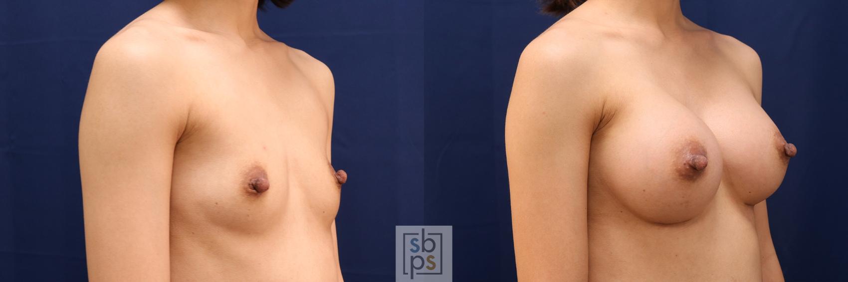 Before & After Breast Augmentation Case 574 Right Oblique View in Torrance & Los Angeles, CA, CA