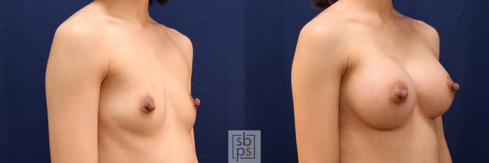 Before & After Breast Augmentation Case 574 Right Oblique View in Torrance, CA