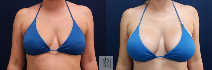 Before & After Breast Augmentation Case 576 Bikini Front View in Torrance, CA