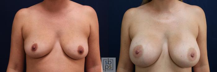 Before & After Breast Augmentation Case 576 Front View in Torrance, CA