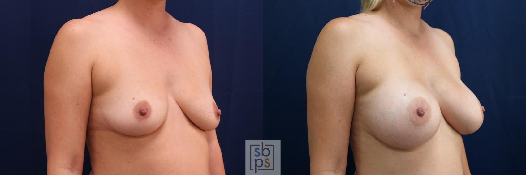 Before & After Breast Augmentation Case 576 Left Oblique View in Torrance & Los Angeles, CA, CA