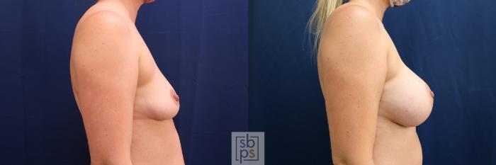 Before & After Breast Augmentation Case 576 Left Side View in Torrance, CA