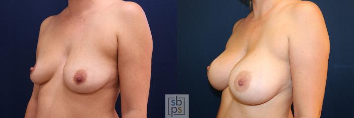 Before & After Breast Augmentation Case 576 Right Oblique View in Torrance, CA