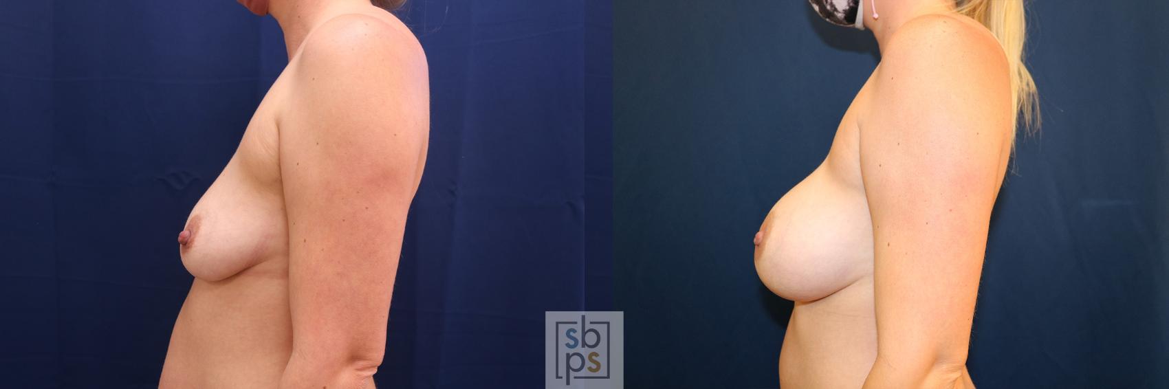 Before & After Breast Augmentation Case 576 Right Side View in Torrance & Los Angeles, CA, CA
