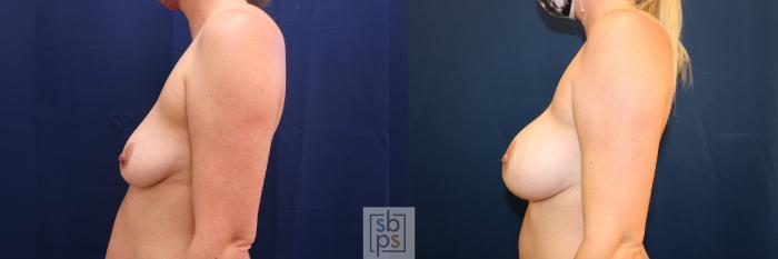 Before & After Breast Augmentation Case 576 Right Side View in Torrance, CA