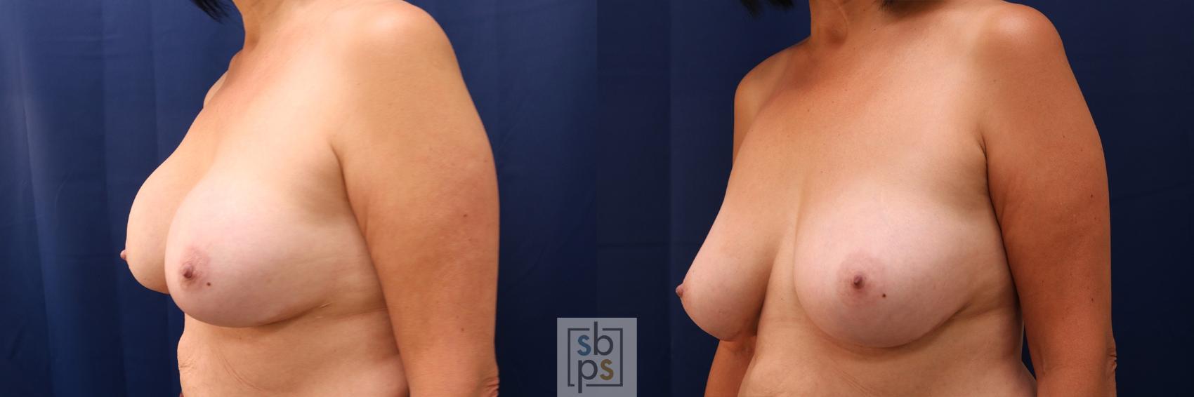 Before & After Breast Augmentation Case 579 Left Oblique View in Torrance & Los Angeles, CA, CA