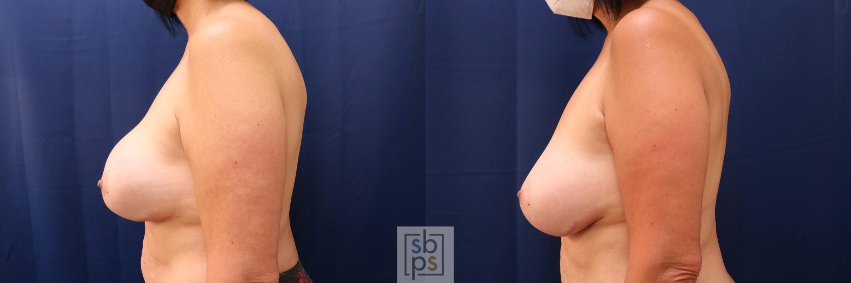 Before & After Breast Augmentation Case 579 Left Side View in Torrance & Los Angeles, CA, CA