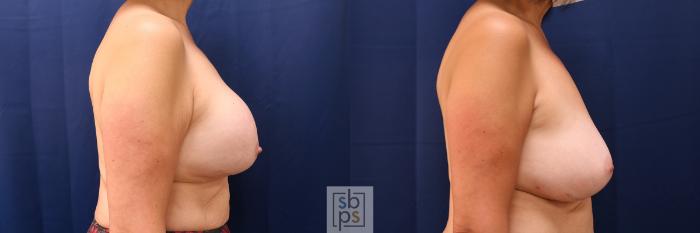 Before & After Breast Augmentation Case 579 Right Side View in Torrance, CA
