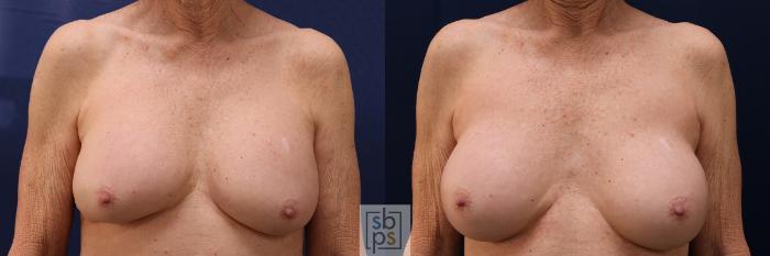 Before & After Breast Augmentation Case 584 Front View in Torrance, CA