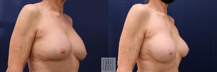 Before & After Breast Augmentation Case 584 Left Oblique View in Torrance, CA