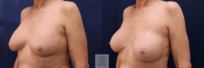 Before & After Breast Augmentation Case 584 Right Oblique View in Torrance, CA