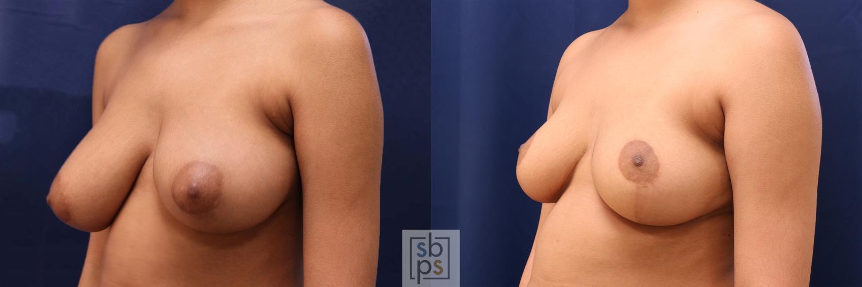 Before & After Breast Augmentation Case 586 Left Oblique View in Torrance & Los Angeles, CA, CA
