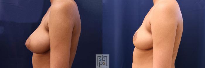 Before & After Breast Reduction Case 586 Left Side View in Torrance, CA