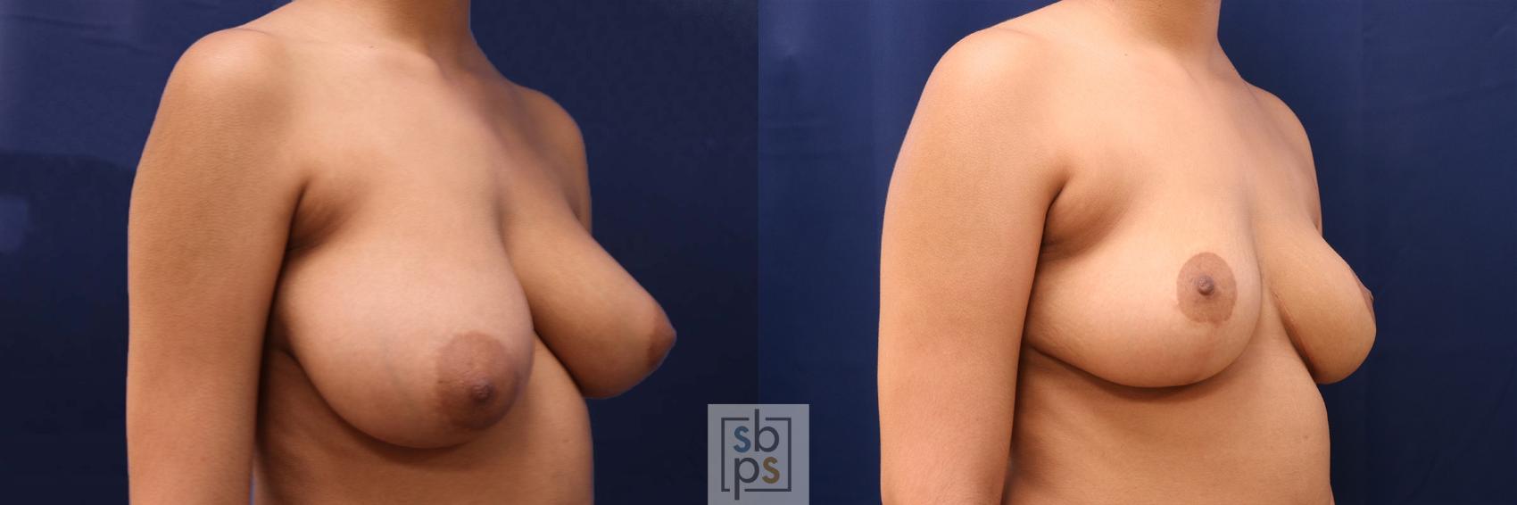 Before & After Breast Augmentation Case 586 Right Oblique View in Torrance & Los Angeles, CA, CA