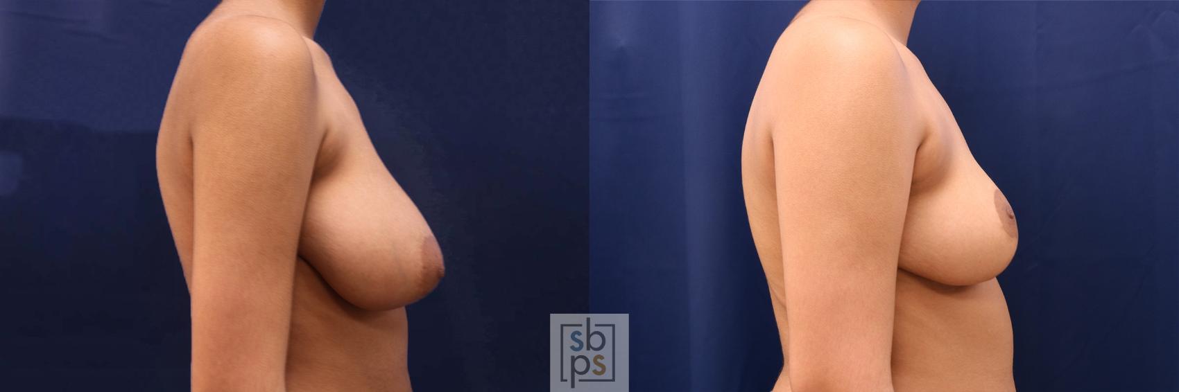 Before & After Breast Augmentation Case 586 Right Side View in Torrance & Los Angeles, CA, CA