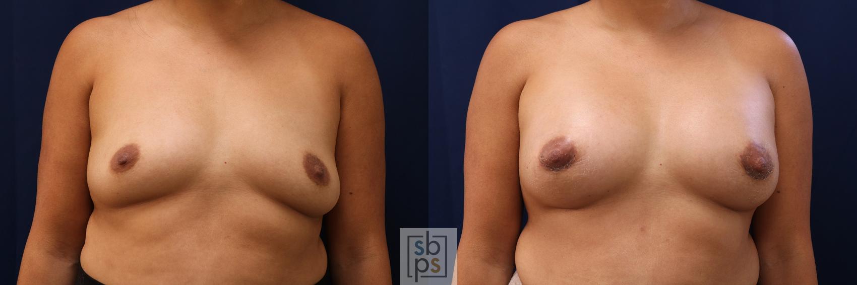 Before & After Breast Augmentation Case 588 Front View in Torrance, CA