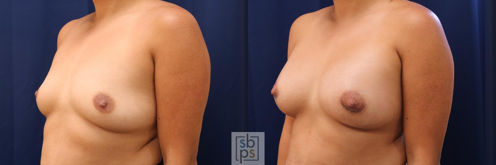 Before & After Breast Augmentation Case 588 Left Oblique View in Torrance & Los Angeles, CA, CA