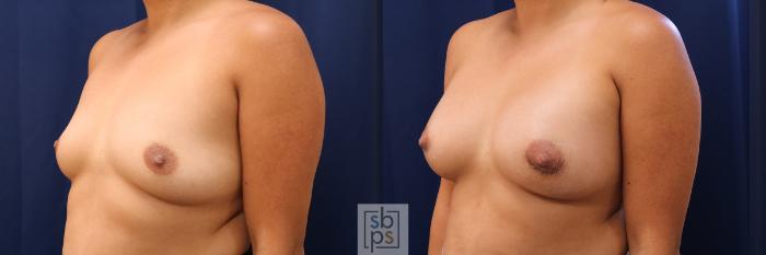 Before & After Breast Augmentation Case 588 Left Oblique View in Torrance, CA
