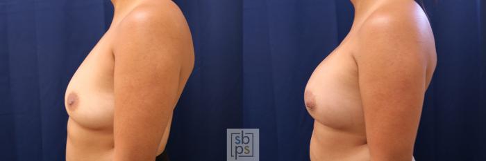 Before & After Breast Augmentation Case 588 Left Side View in Torrance, CA