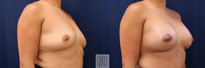 Before & After Breast Augmentation Case 588 Right Oblique View in Torrance, CA