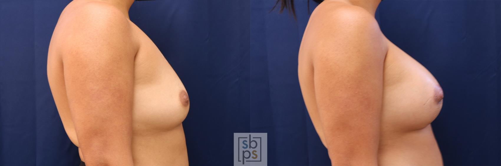 Before & After Breast Augmentation Case 588 Right Side View in Torrance & Los Angeles, CA, CA