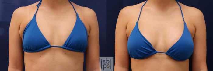 Before & After Breast Augmentation Case 589 Bikini Front View in Torrance, CA
