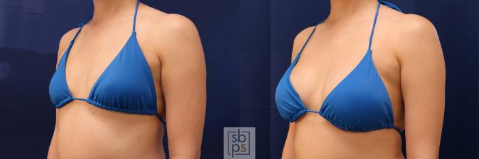 Before & After Breast Augmentation Case 589 Bikini Left Oblique View in Torrance, CA