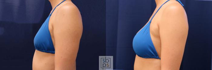 Before & After Breast Augmentation Case 589 Bikini Left View in Torrance, CA