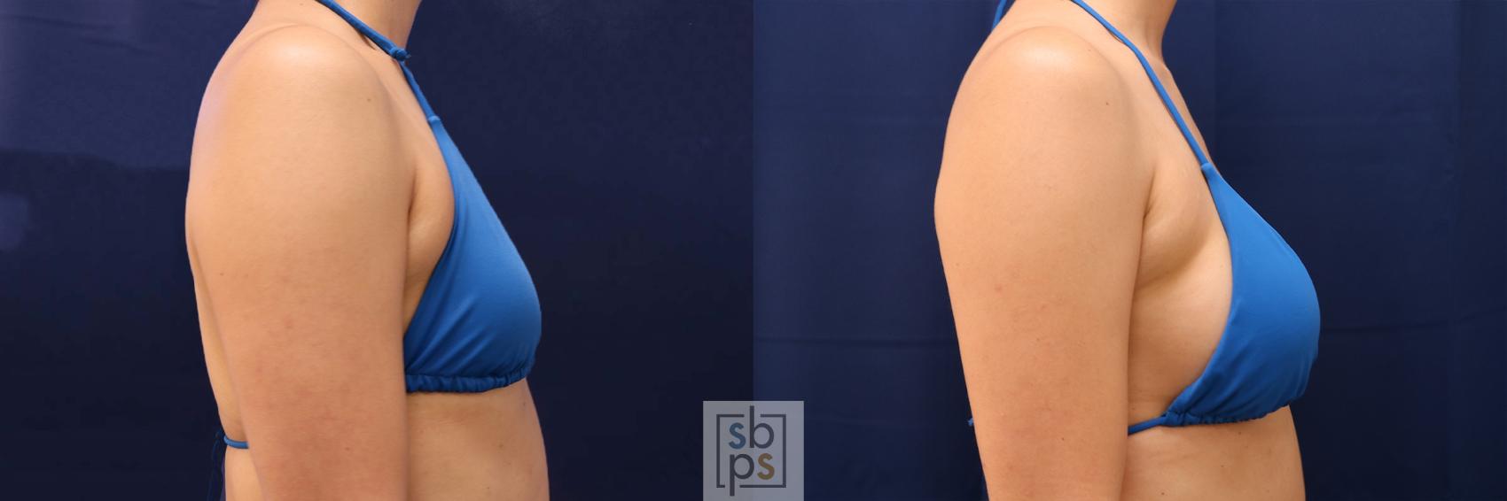 Before & After Breast Augmentation Case 589 Bikini Right View in Torrance & Los Angeles, CA, CA