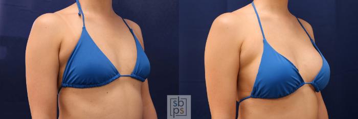 Before & After Breast Augmentation Case 589 Bikini Right Oblique View in Torrance, CA