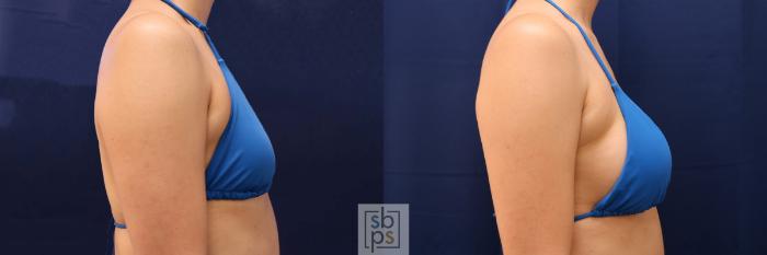 Before & After Breast Augmentation Case 589 Bikini Right View in Torrance, CA