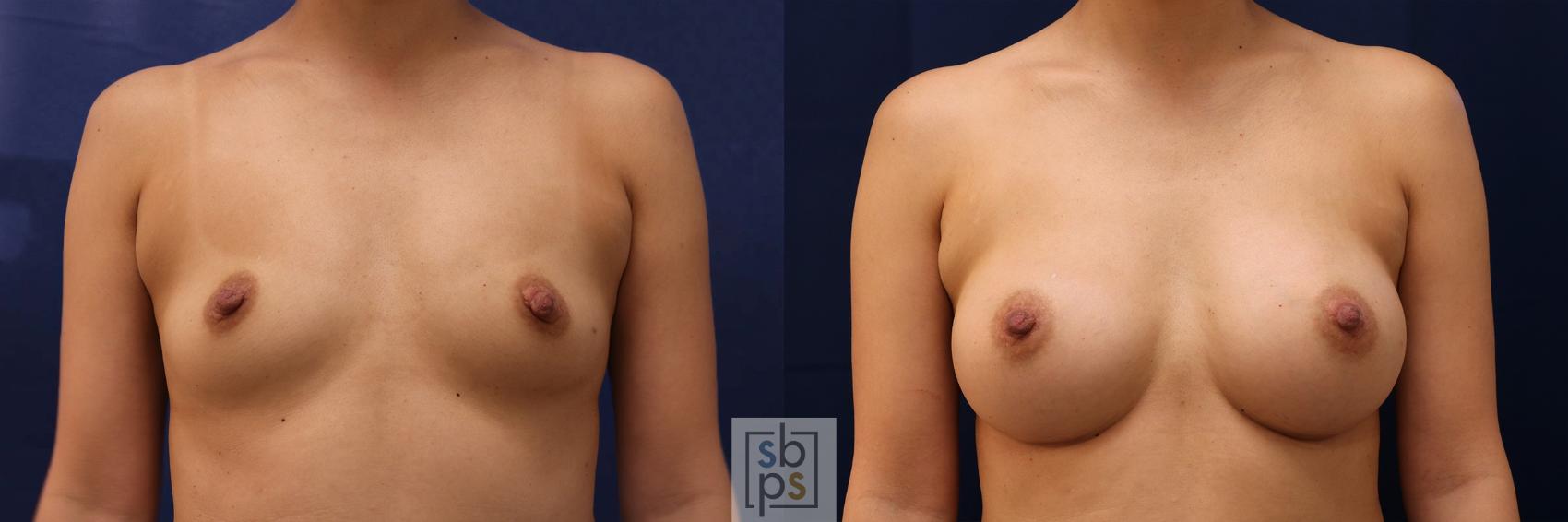 Before & After Breast Augmentation Case 589 Front View in Torrance, CA