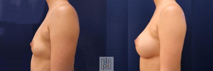 Before & After Breast Augmentation Case 589 Left Side View in Torrance, CA
