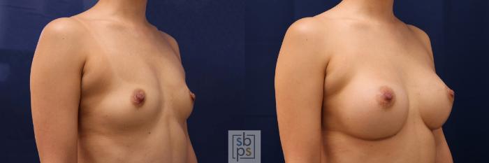 Before & After Breast Augmentation Case 589 Right Oblique View in Torrance, CA